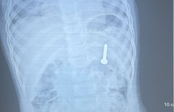 1-1776140322-7918-1776140436 Đinh vít năm trong dạ dày bé gái. Ảnh: Bệnh viện cung cấp
