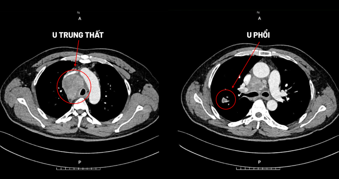 Ảnh chụp CT cho thấy người bệnh cùng lúc mắc u trung thất và u phổi trong lồng ngực. Ảnh: Bệnh viện Đa khoa Tâm Anh