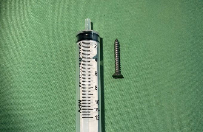a2-1776140330-7620-1776140436 Đinh vít được lấy ra từ dạ dày bệnh nhân. Ảnh: Bệnh viên cung cấp