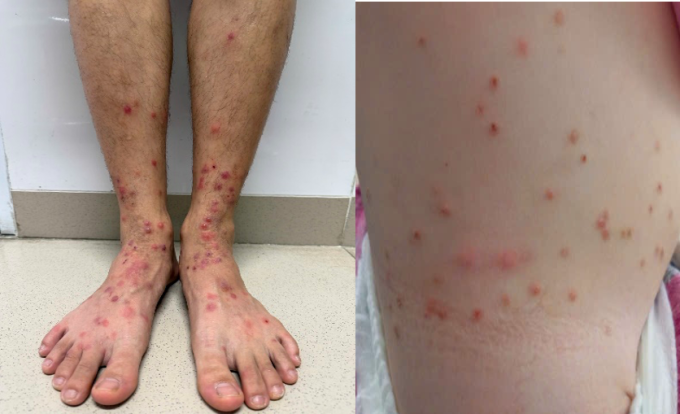 Tổn thương da do bọ chét tấn công. Ảnh: Bệnh viện cung cấp