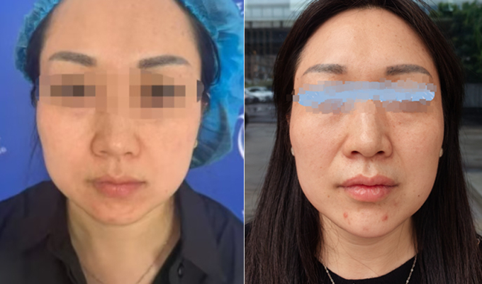 Cô Vương trước và sau khi tiêm chất làm đẹp. Ảnh: The Cover