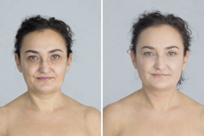 Từ trái sang phải: trước và sau khi sử dụng công nghệ Plasma Complex. Ảnh: KeyMed