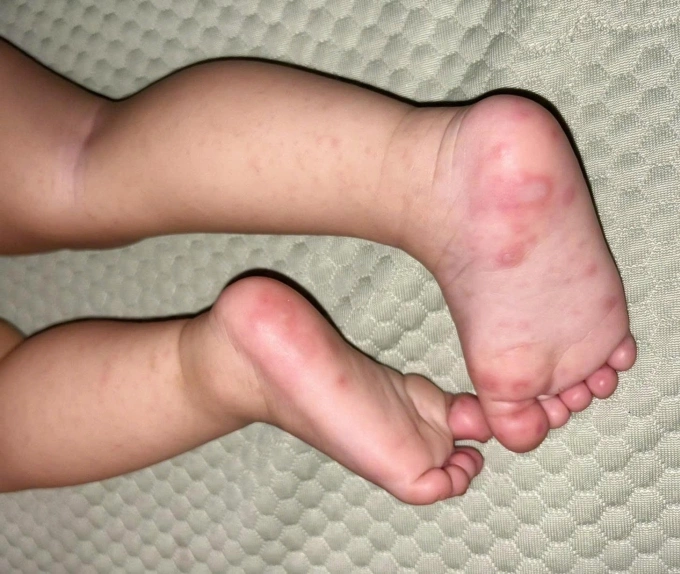 Các nốt mụn nước, rát đỏ xuất hiện ở chân của bé My. Ảnh: Người nhà cung cấp