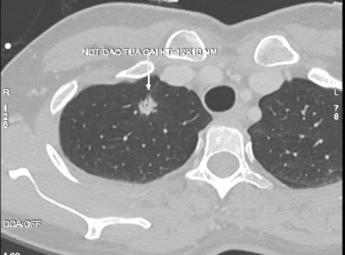ngothihongluongnotphoi-1776054-4668-3635-1776055030 Nốt phổi nguy cơ cao của bà Liên trên phim chụp CT. Ảnh: Bệnh viện Đa khoa Tâm Anh